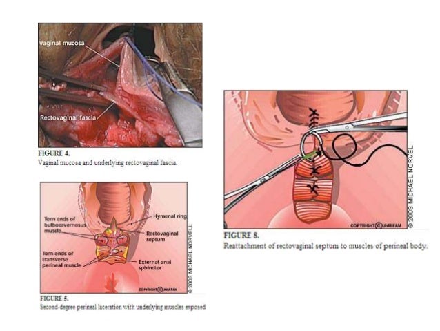pictures of vaginal tears or episiotomy Pictures of vaginal tears or episiotomy
